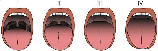 Difficult airway characteristics associated with video laryngoscopy ...